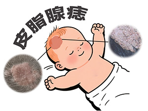 <strong>皮脂腺痣会越长越大吗？增长速度快不快？</strong>