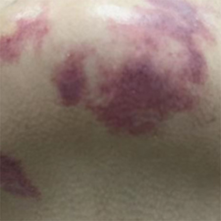 怎样科学应对鲜红斑痣？南京哪里治鲜红斑痣？